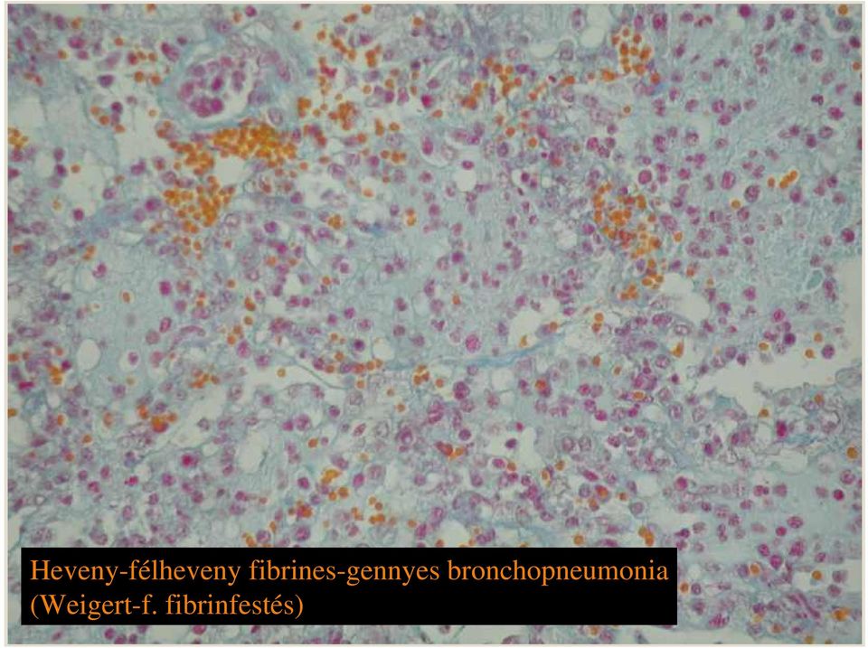 bronchopneumonia