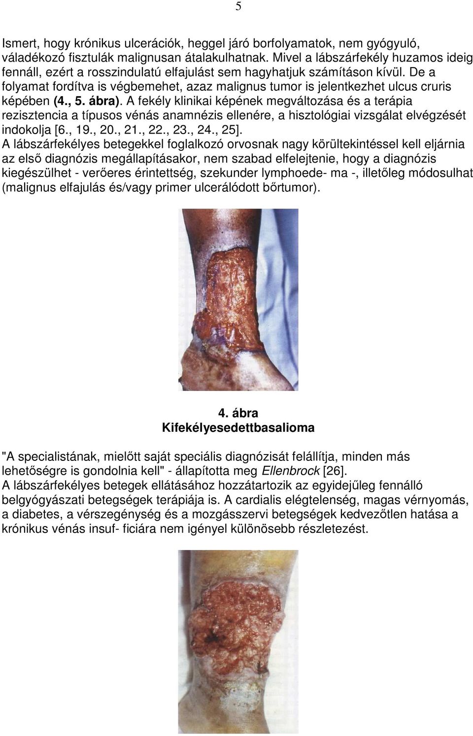 De a folyamat fordítva is végbemehet, azaz malignus tumor is jelentkezhet ulcus cruris képében (4., 5. ábra).