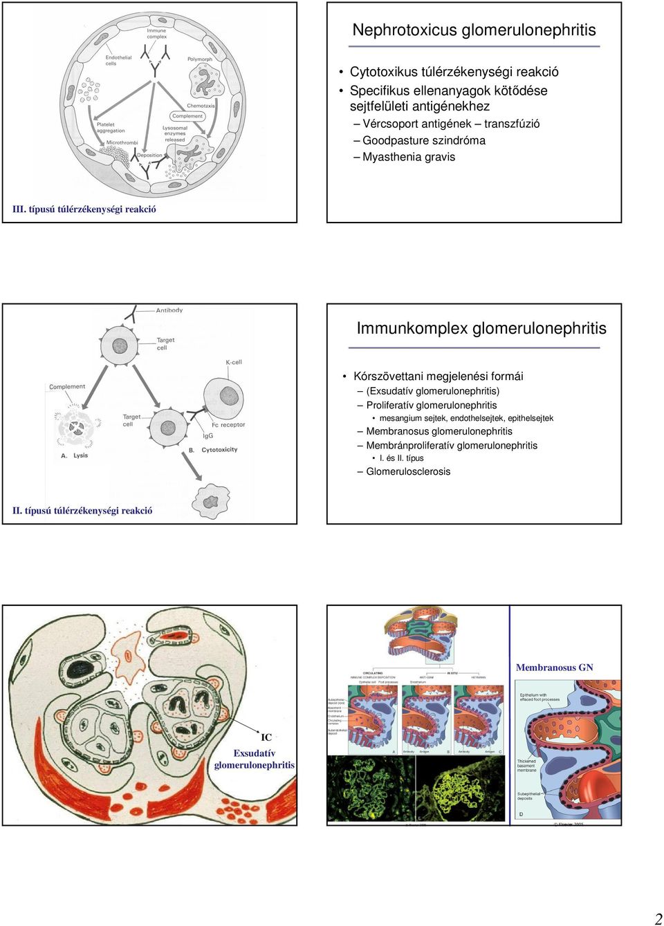 típusú túlérzékenységi reakció Immunkomplex glomerulonephritis Kórszövettani megjelenési formái (Exsudatív glomerulonephritis) Proliferatív