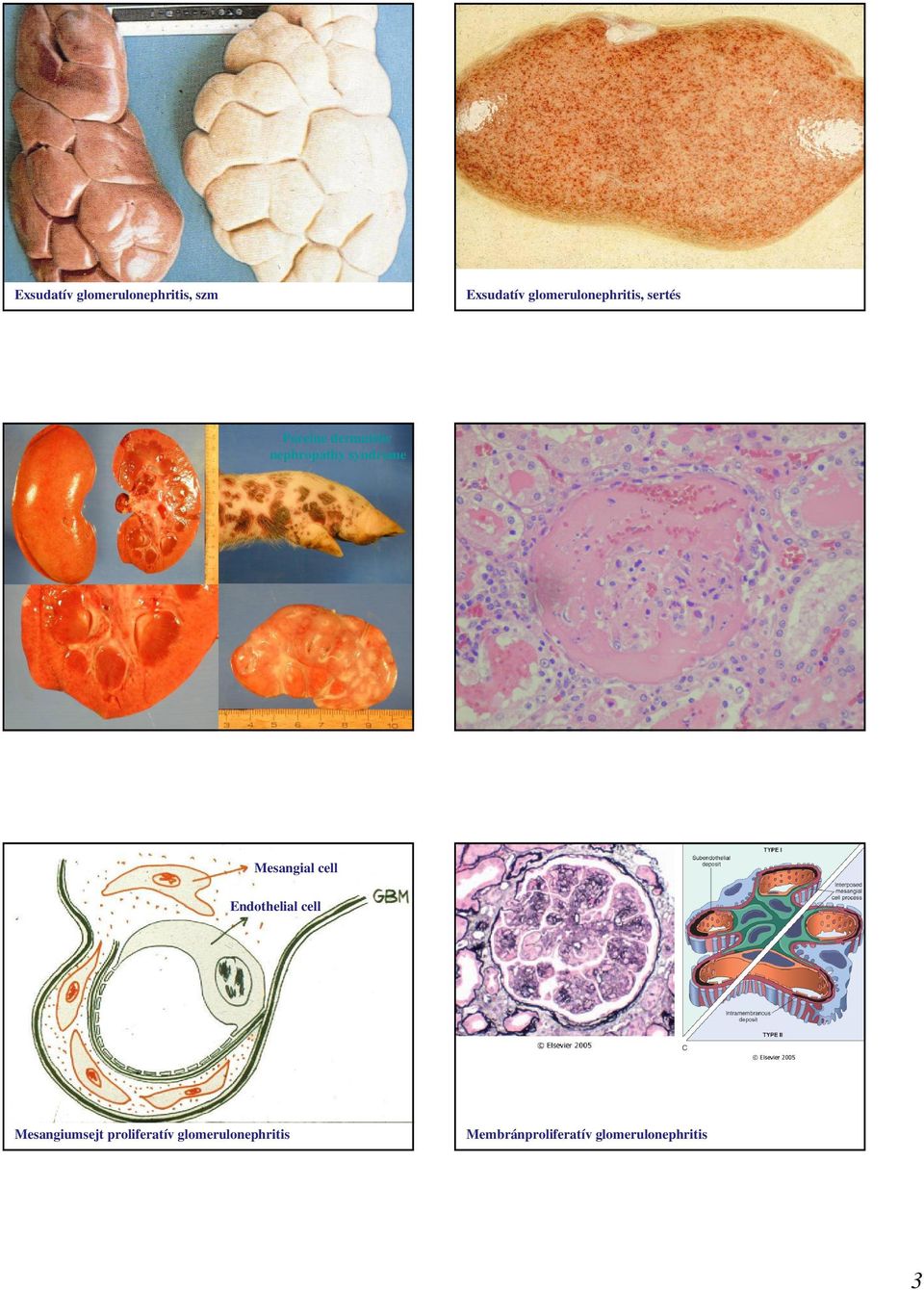 syndrome Mesangial cell Endothelial cell Mesangiumsejt