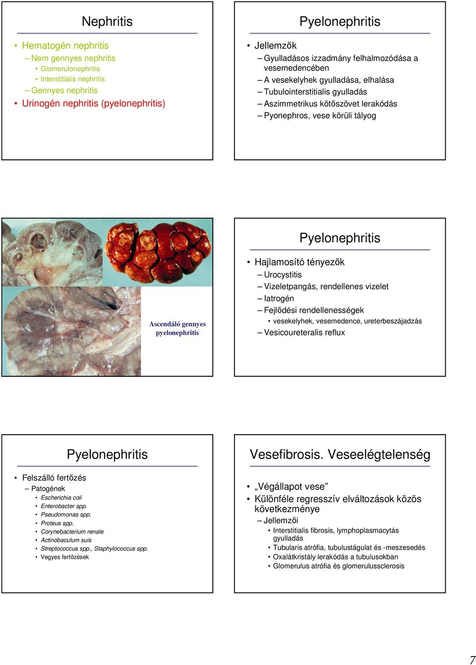 pyelonephritis Hajlamosító tényezık Urocystitis Vizeletpangás, rendellenes vizelet Iatrogén Fejlıdési rendellenességek vesekelyhek, vesemedence, ureterbeszájadzás Vesicoureteralis reflux