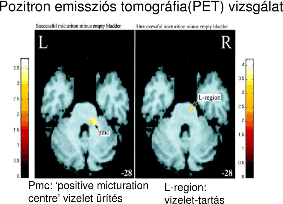 Pmc: positive micturation