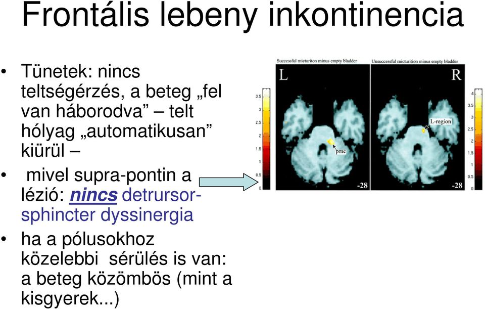 supra-pontin a lézió: nincs detrursorsphincter dyssinergia ha a