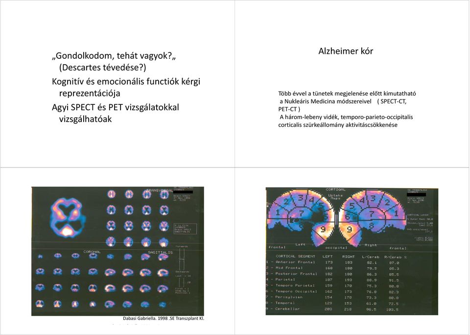 Alzheimer kór Több évvel a tünetek megjelenése előtt kimutatható a Nukleáris Medicina módszereivel ( SPECT