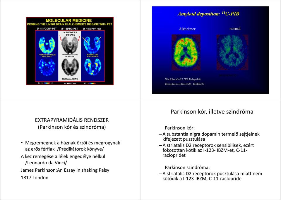 remegése a lélek engedélye nélkül /Leonardo da Vinci/ James Parkinson:An Essay in shaking Palsy 1817 London Parkinson kór, illetve szindróma
