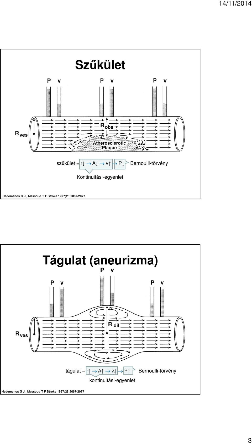 1997;28:2067-2077 Tágulat (aneurizma) tágulat = r A v P