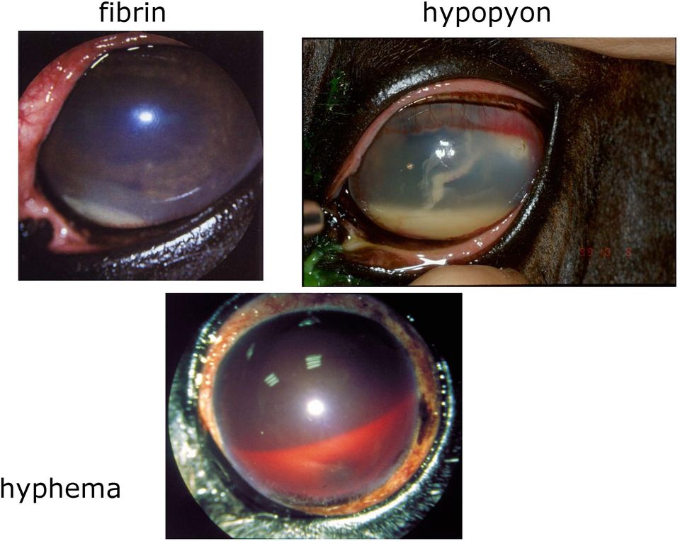 hyphema