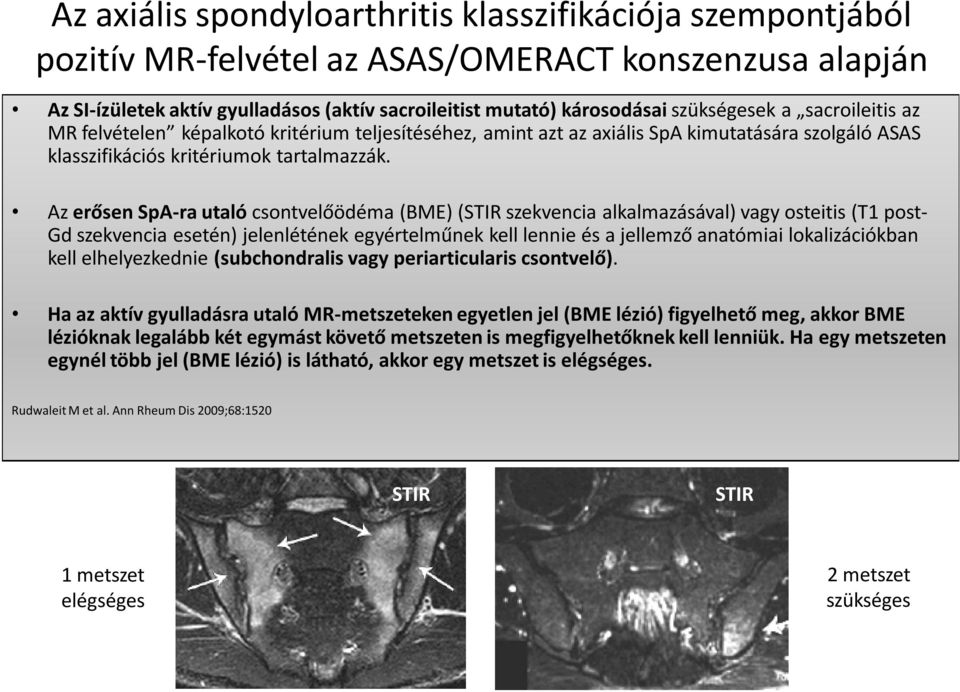 Az erősen SpA-ra utaló csontvelőödéma (BME) (STIR szekvencia alkalmazásával) vagy osteitis (T1 post- Gd szekvencia esetén) jelenlétének egyértelműnek kell lennie és a jellemző anatómiai