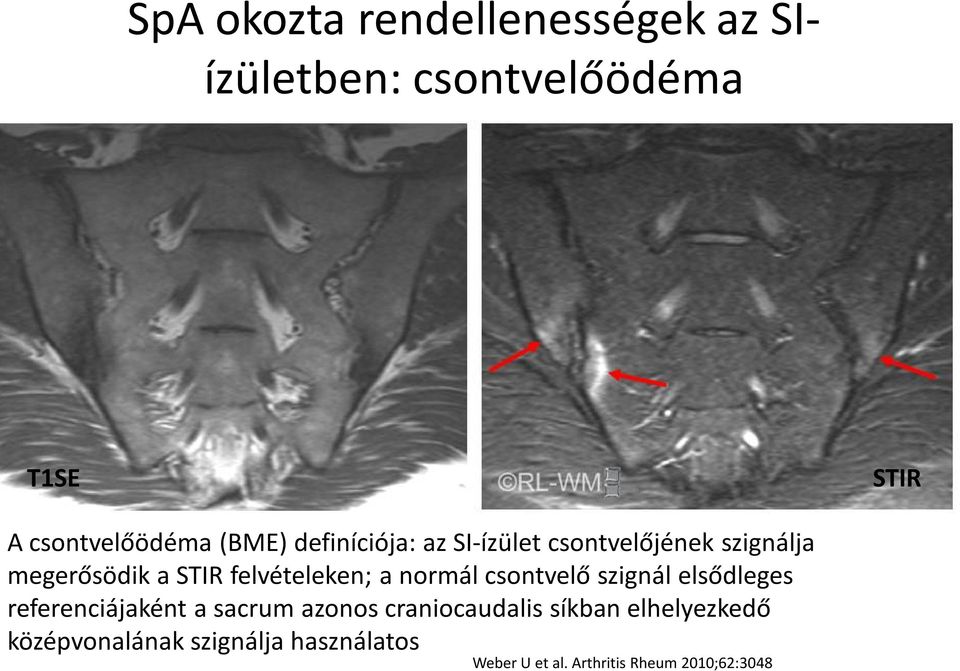 a normál csontvelő szignál elsődleges referenciájaként a sacrum azonos craniocaudalis