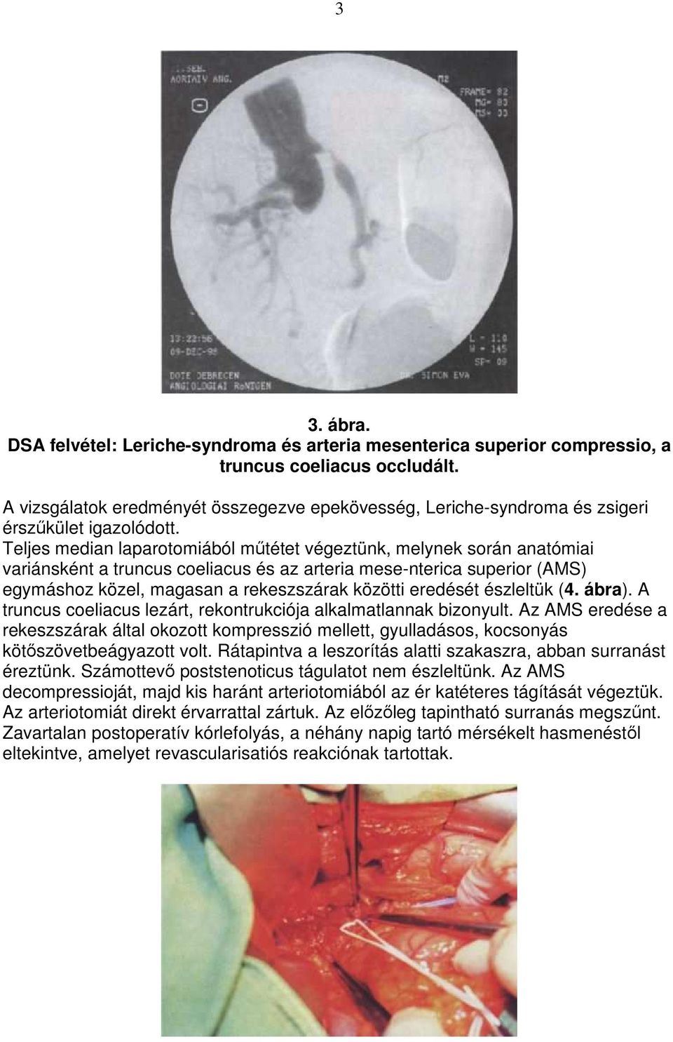 Teljes median laparotomiából mőtétet végeztünk, melynek során anatómiai variánsként a truncus coeliacus és az arteria mese-nterica superior (AMS) egymáshoz közel, magasan a rekeszszárak közötti