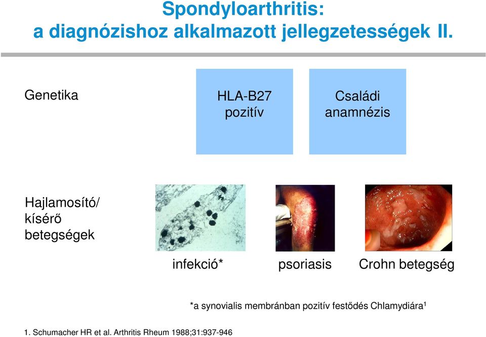 Genetika HLA-B27 pozitív Családi anamnézis Hajlamosító/ kísérő betegségek infekció*