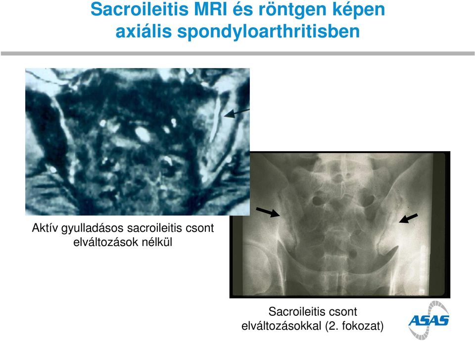 sacroileitis csont elváltozások nélkül