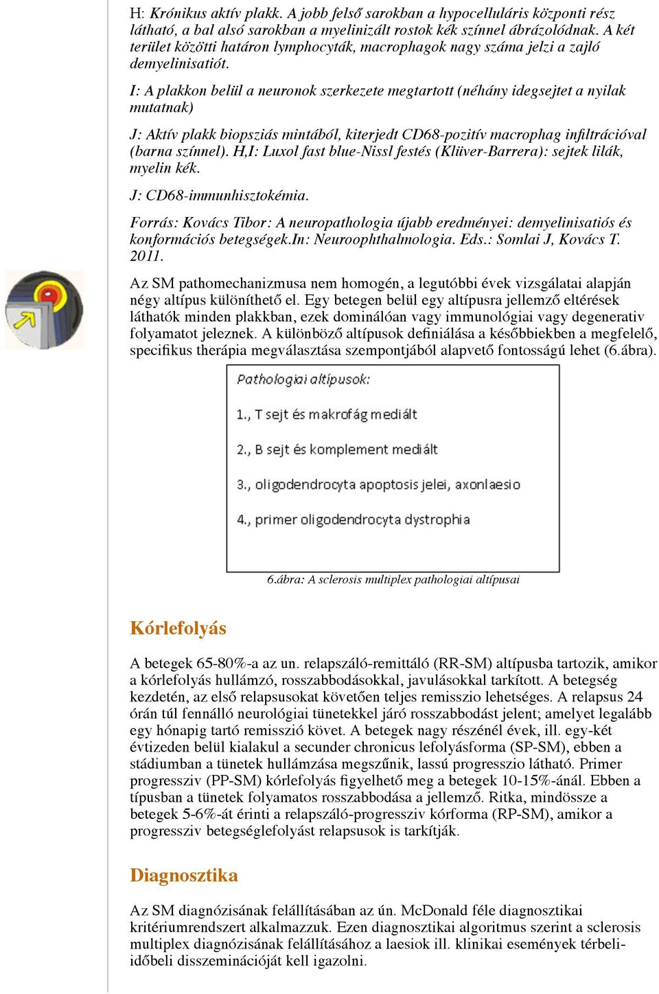 I: A plakkon belül a neuronok szerkezete megtartott (néhány idegsejtet a nyilak mutatnak) J: Aktív plakk biopsziás mintából, kiterjedt CD68-pozitív macrophag infiltrációval (barna színnel).