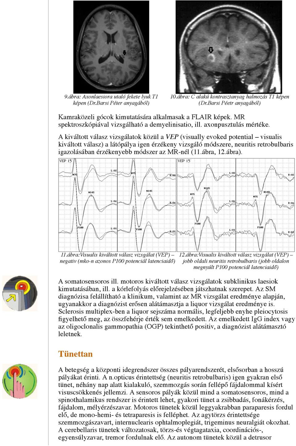 A kiváltott válasz vizsgálatok közül a VEP (visually evoked potential visualis kiváltott válasz) a látópálya igen érzékeny vizsgáló módszere, neuritis retrobulbaris igazolásában érzékenyebb módszer