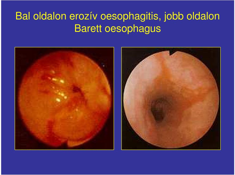 oesophagitis,