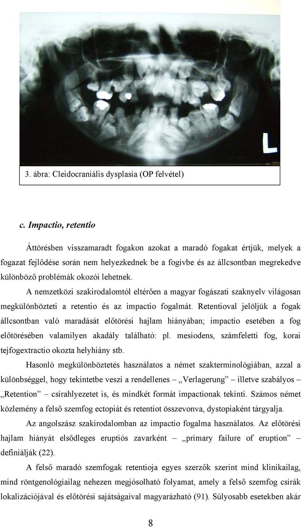 okozói lehetnek. A nemzetközi szakirodalomtól eltérően a magyar fogászati szaknyelv világosan megkülönbözteti a retentio és az impactio fogalmát.