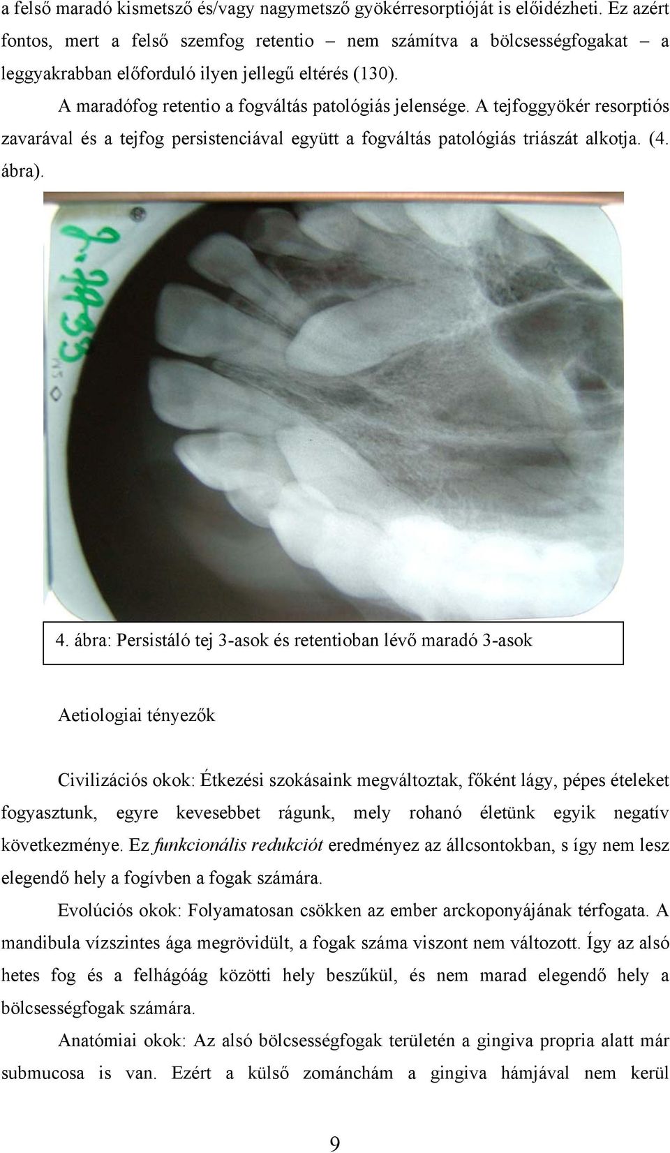 A tejfoggyökér resorptiós zavarával és a tejfog persistenciával együtt a fogváltás patológiás triászát alkotja. (4. ábra). 4.