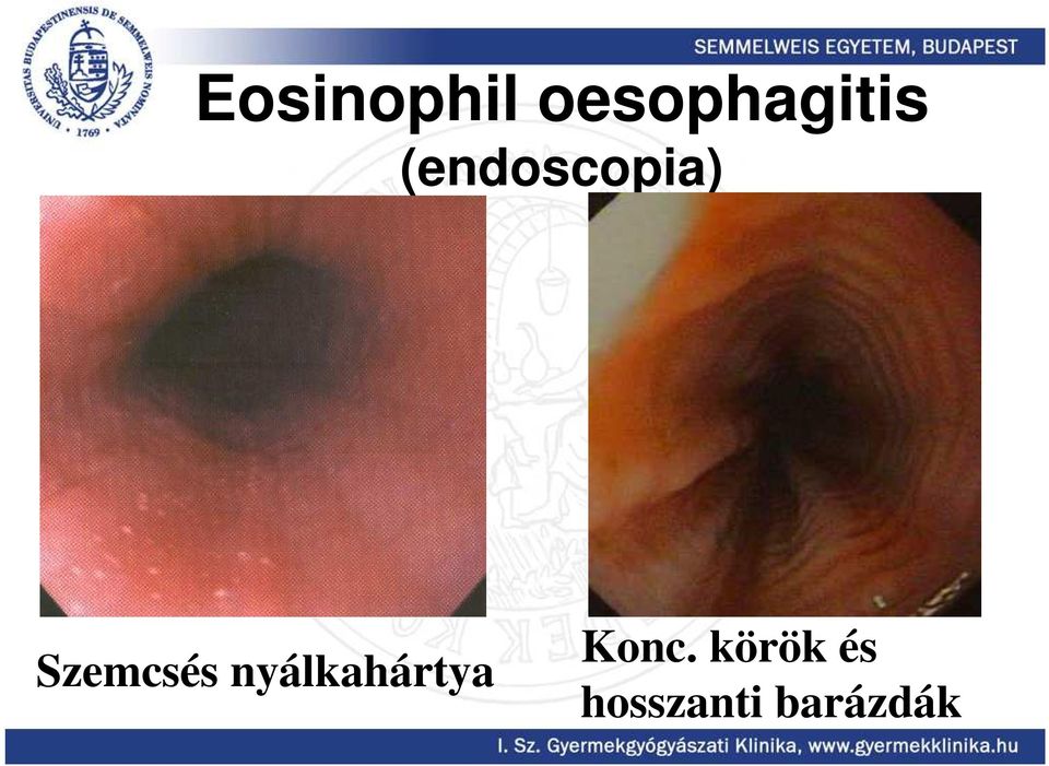 (endoscopia) Szemcsés