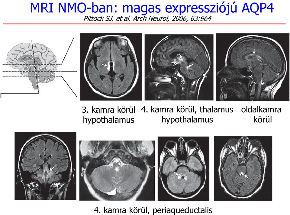 kamra körül, thalamus oldalkamra lk hypothalamus