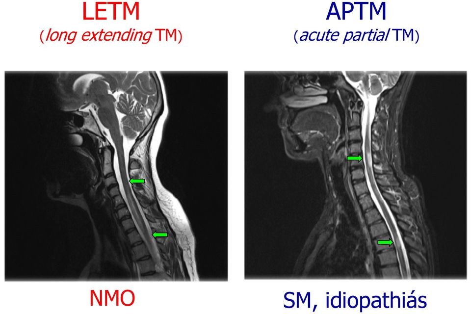 APTM (acute