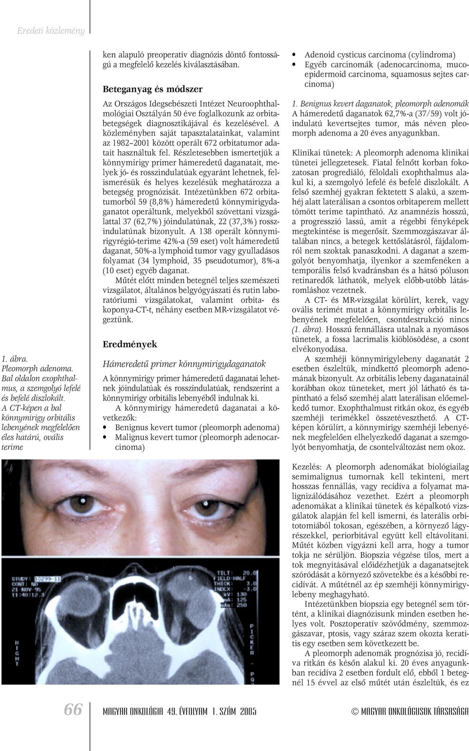 Beteganyag és módszer Az Országos Idegsebészeti Intézet Neuroophthalmológiai Osztályán 50 éve foglalkozunk az orbitabetegségek diagnosztikájával és kezelésével.