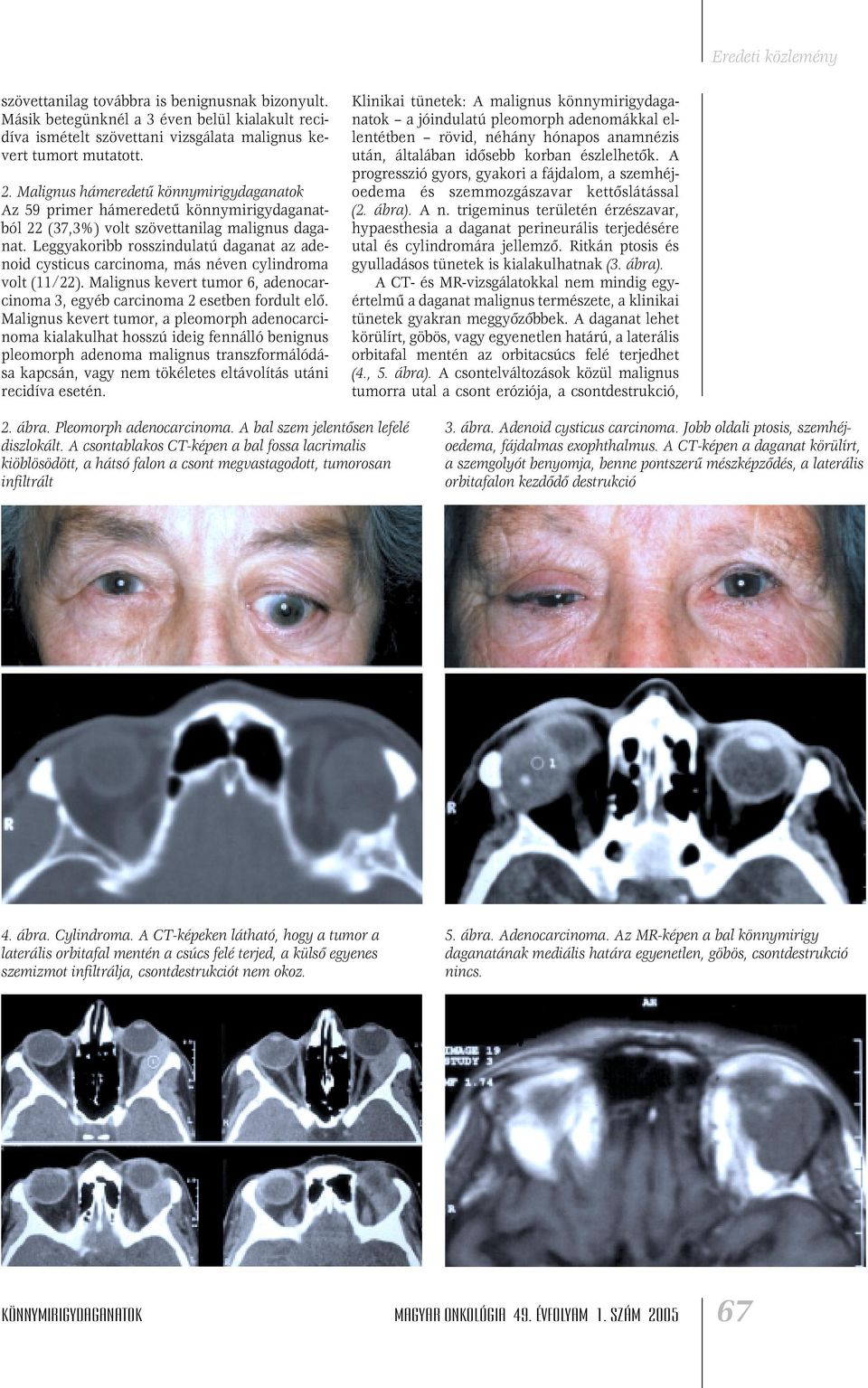 Leggyakoribb rosszindulatú daganat az adenoid cysticus carcinoma, más néven cylindroma volt (11/22). Malignus kevert tumor 6, adenocarcinoma 3, egyéb carcinoma 2 esetben fordult elô.