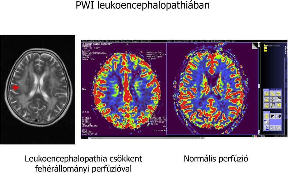 Leukoencephalopathia