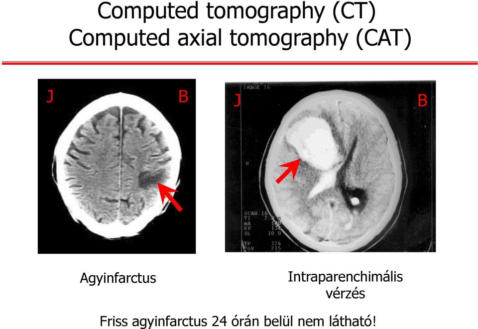 Agyinfarctus Intraparenchimális