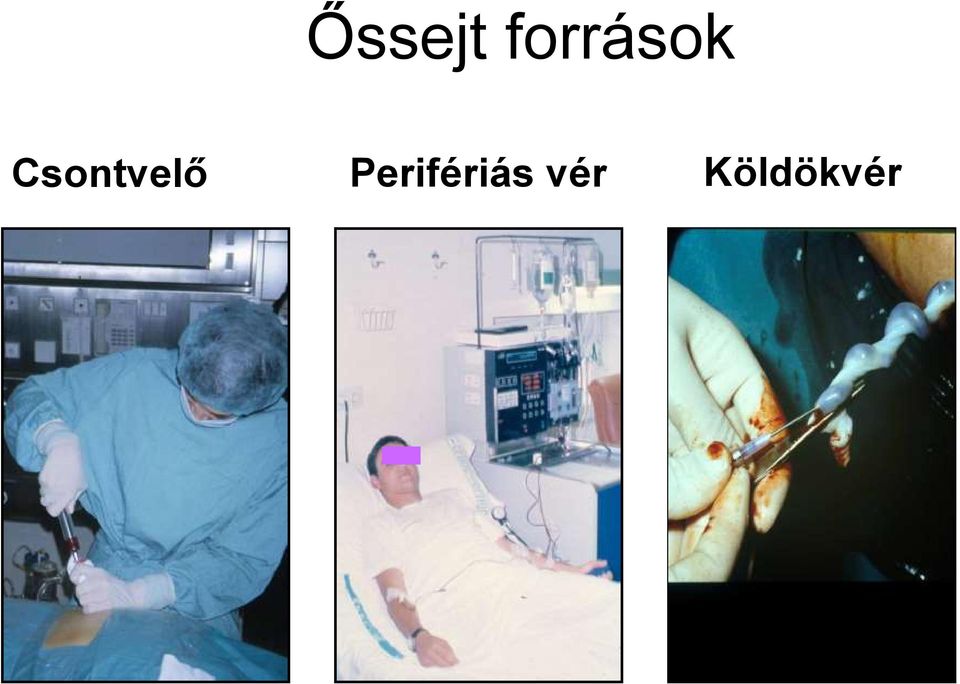 Már Debrecenben is van allogén csontvelő-transzplantáció
