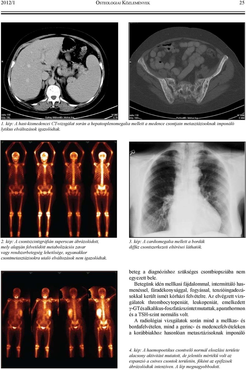 kép: A csontszcintigráfián superscan ábrázolódott, mely alapján felvetődött metabolizációs zavar vagy rendszerbetegség lehetősége, ugyanakkor csontmetasztázisokra utaló elváltozások nem igazolódtak.