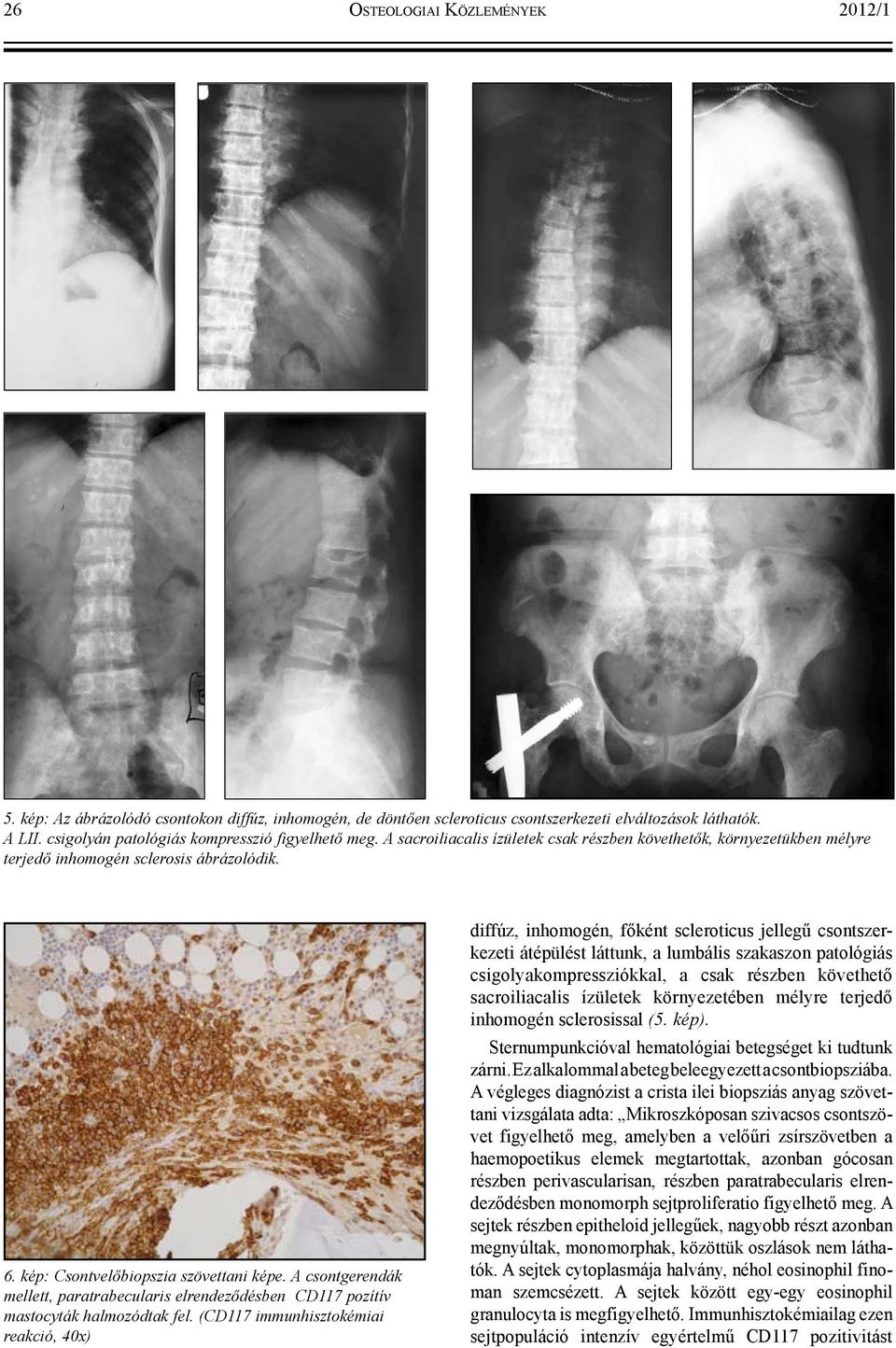 kép: Csontvelőbiopszia szövettani képe. A csontgerendák mellett, paratrabecularis elrendeződésben CD117 pozítív mastocyták halmozódtak fel.