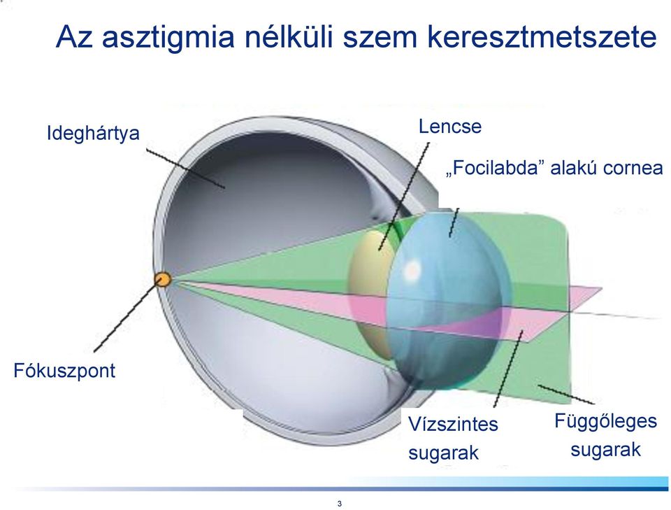 Focilabda alakú cornea Fókuszpont