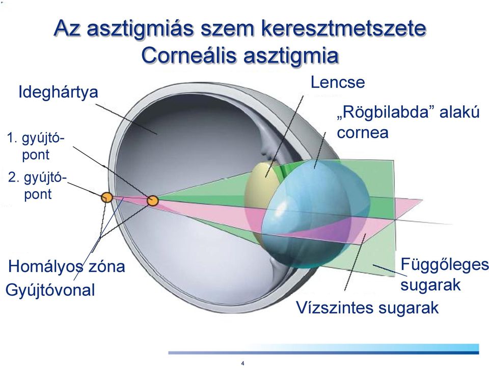 gyújtópont Lencse Rögbilabda alakú cornea
