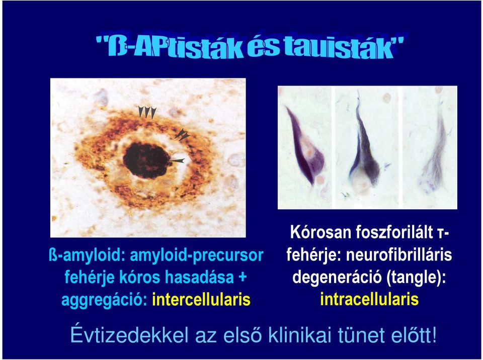 τ- fehérje: neurofibrilláris degeneráció (tangle):