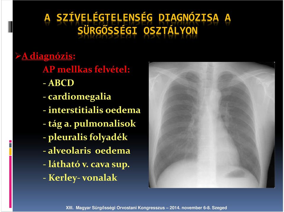 interstitialis oedema - tág a.