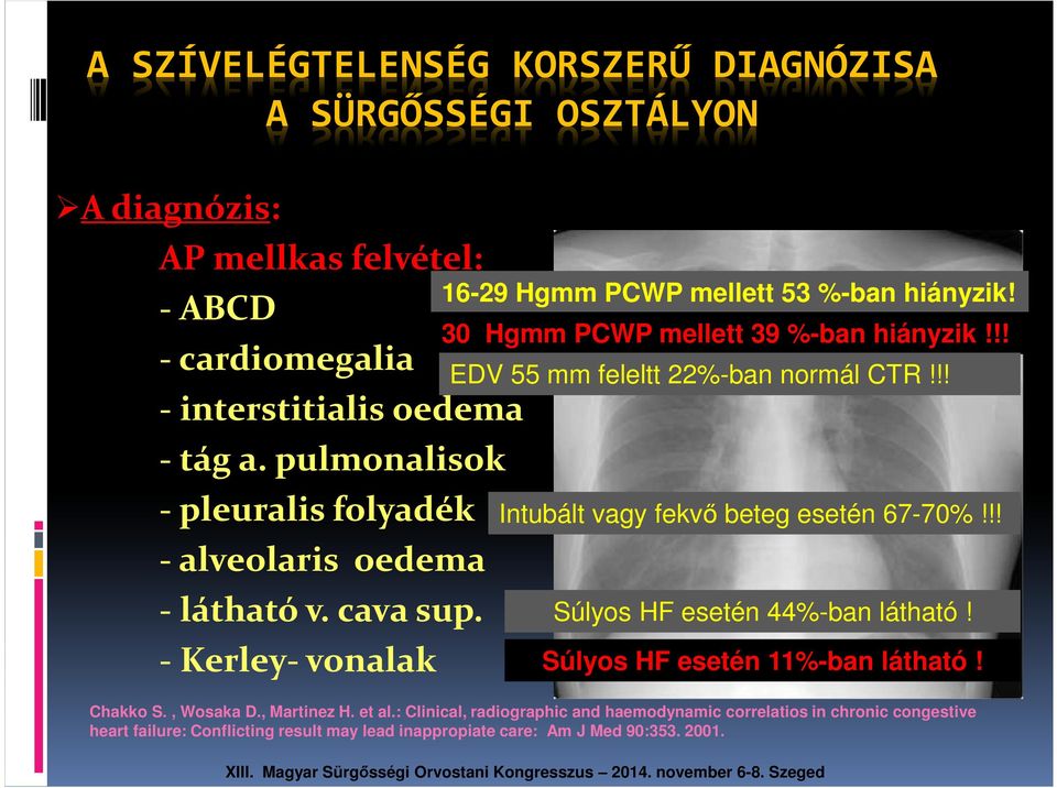 30 Hgmm PCWP mellett 39 %-ban hiányzik!!! EDV 55 mm feleltt 22%-ban normál CTR!!! Intubált vagy fekvő beteg esetén 67-70%!!! Súlyos HF esetén 44%-ban látható!