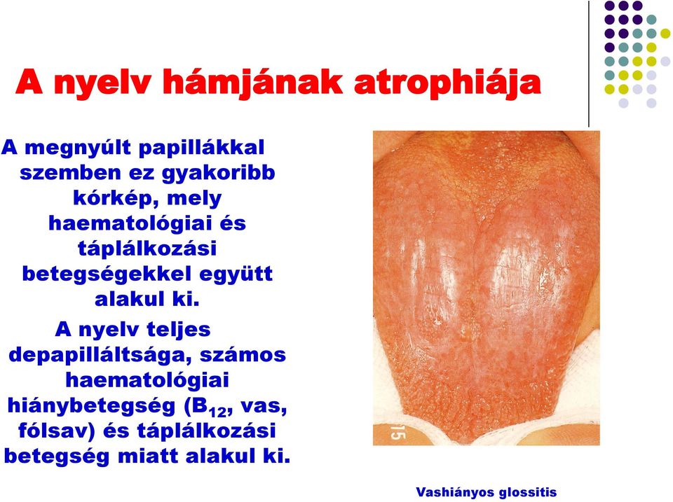 A nyelv teljes depapilláltsága, számos haematológiai hiánybetegség (B 12,