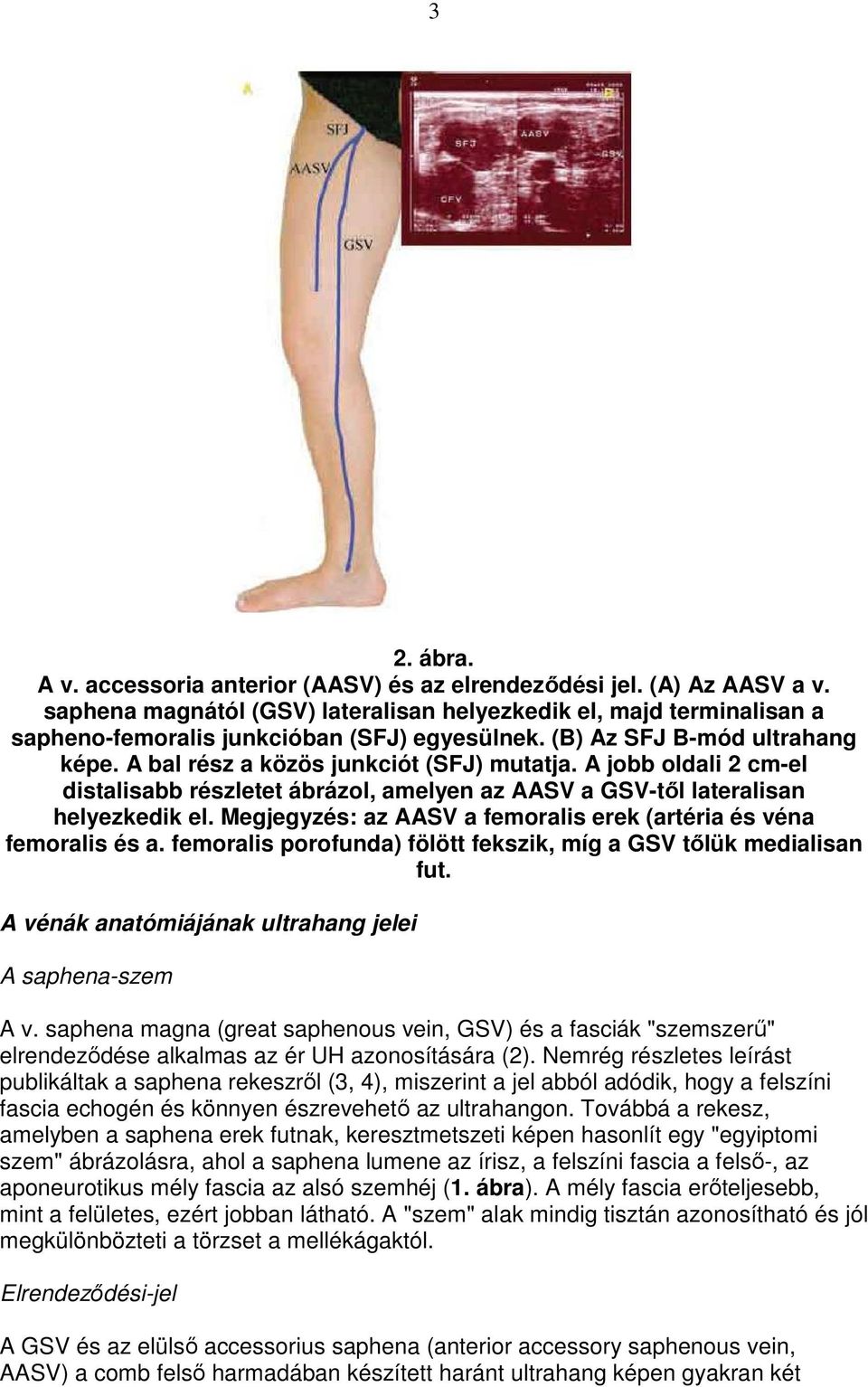 A jobb oldali 2 cm-el distalisabb részletet ábrázol, amelyen az AASV a GSV-tıl lateralisan helyezkedik el. Megjegyzés: az AASV a femoralis erek (artéria és véna femoralis és a.