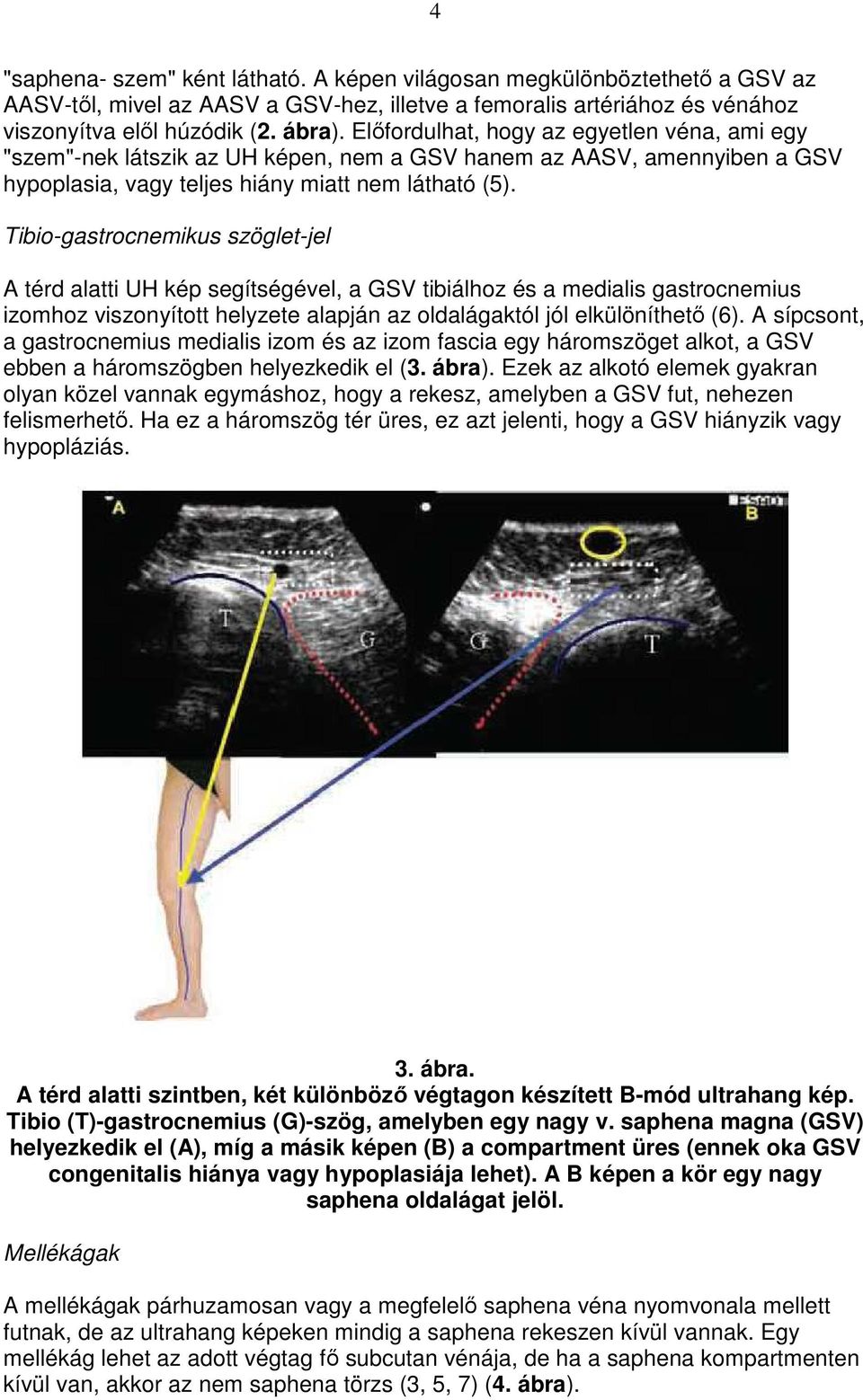 Tibio-gastrocnemikus szöglet-jel A térd alatti UH kép segítségével, a GSV tibiálhoz és a medialis gastrocnemius izomhoz viszonyított helyzete alapján az oldalágaktól jól elkülöníthetı (6).