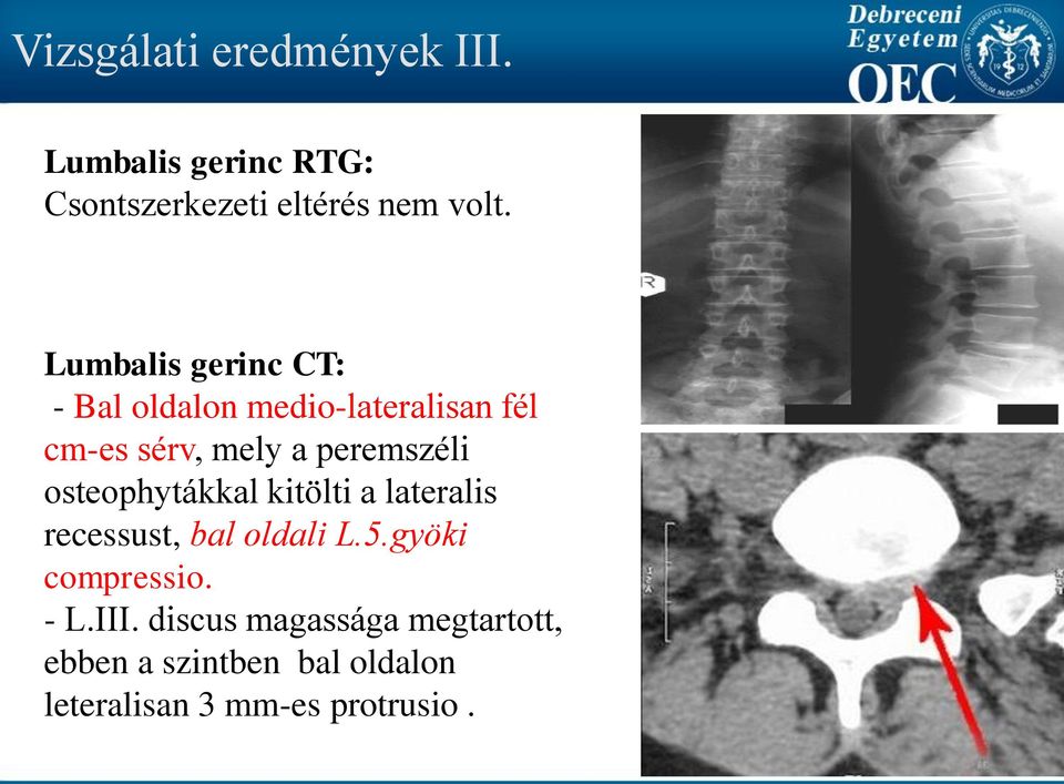 osteophytákkal kitölti a lateralis recessust, bal oldali L.5.gyöki compressio. - L.