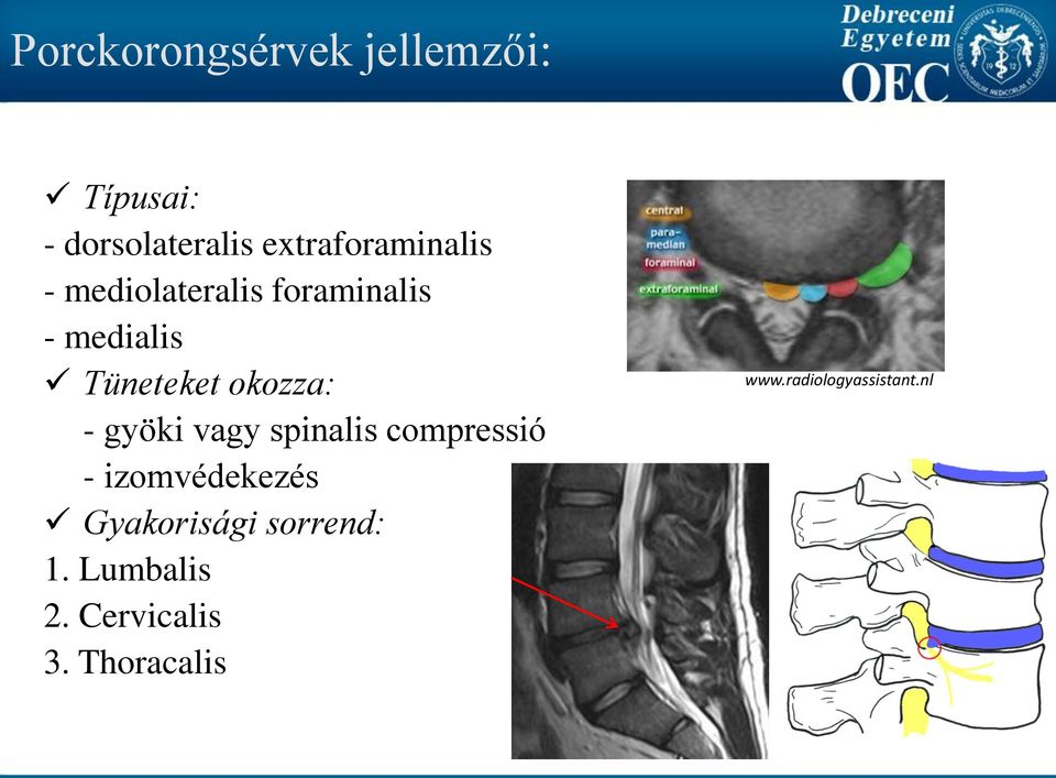 Tüneteket okozza: - gyöki vagy spinalis compressió -