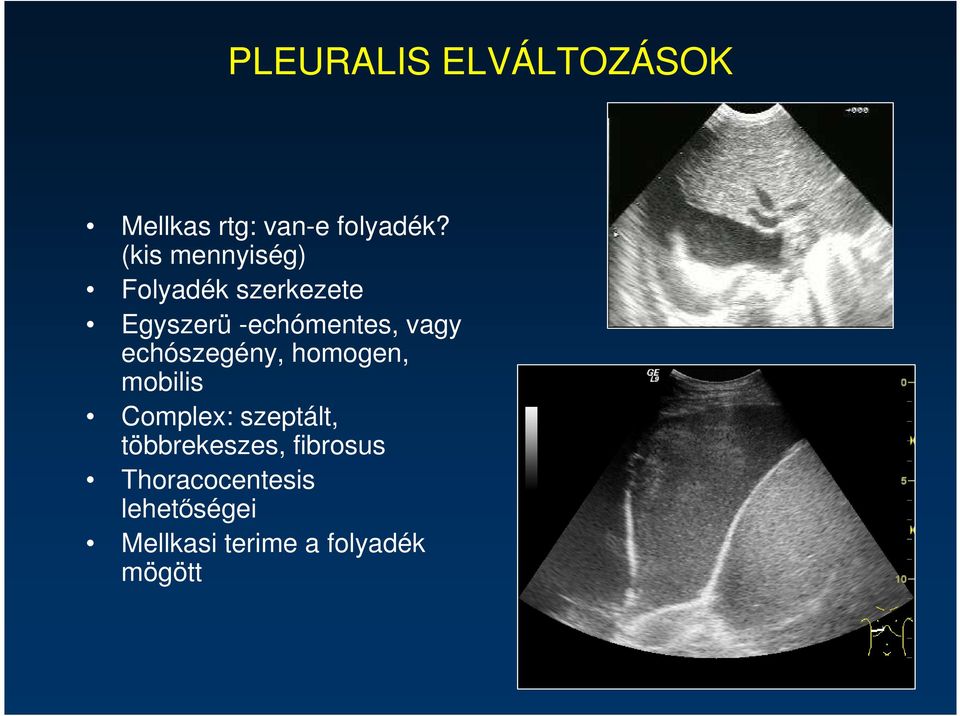 vagy echószegény, homogen, mobilis Complex: szeptált,