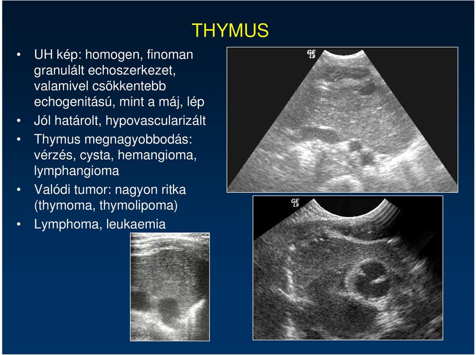 hypovascularizált Thymus megnagyobbodás: vérzés, cysta, hemangioma,