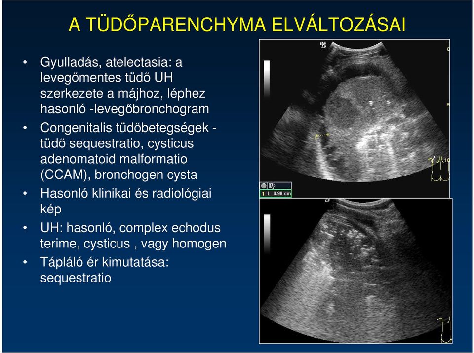 cysticus adenomatoid malformatio (CCAM), bronchogen cysta Hasonló klinikai és radiológiai