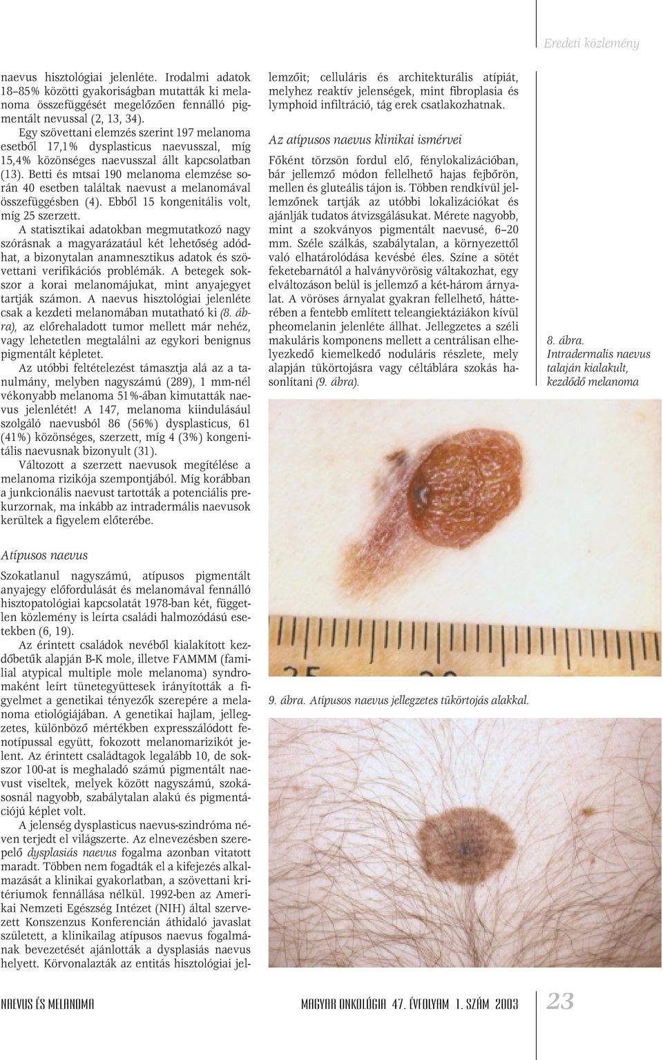 Betti és mtsai 190 melanoma elemzése során 40 esetben találtak naevust a melanomával összefüggésben (4). Ebbôl 15 kongenitális volt, míg 25 szerzett.