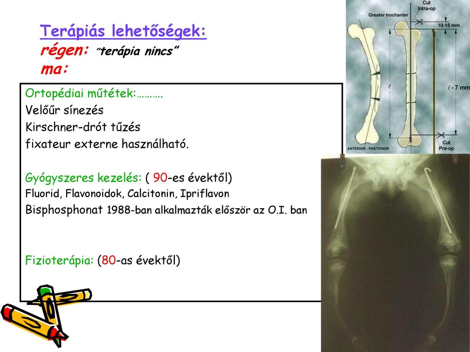 Gyógyszeres kezelés: ( 90-es évektől) Fluorid, Flavonoidok, Calcitonin,