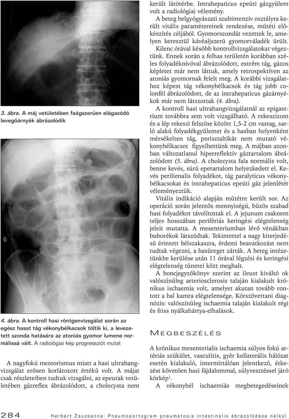 A májat csak részleteiben tudtuk vizsgálni, az epeutak vetületében gázreflex ábrázolódott, a cholecysta nem került látótérbe. Intrahepaticus epeúti gázgyülem volt a radiológiai vélemény.