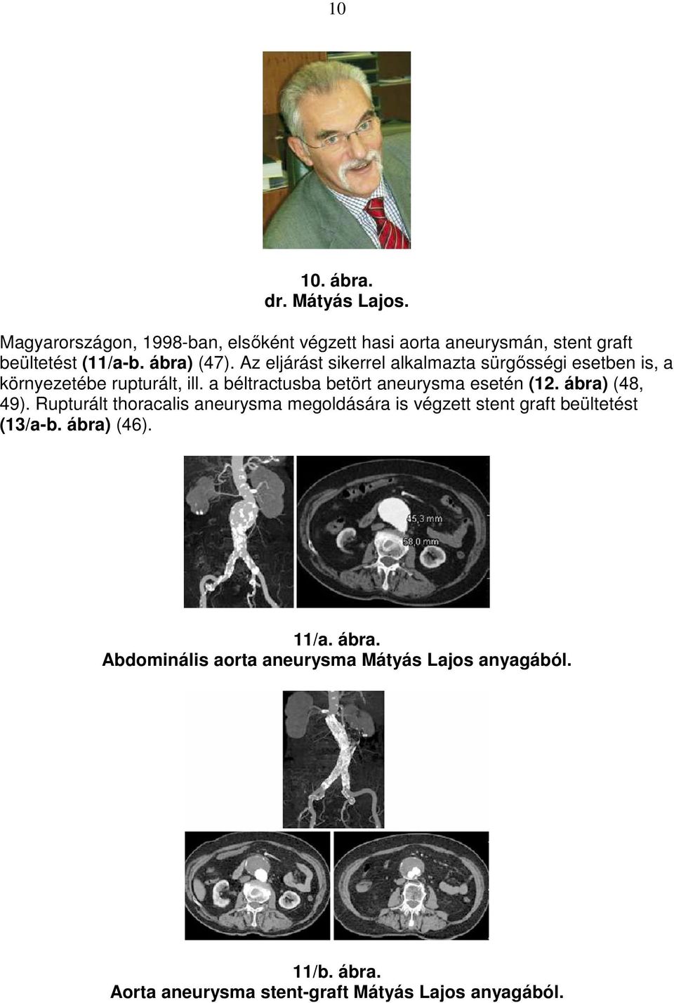 a béltractusba betört aneurysma esetén (12. ábra) (48, 49).