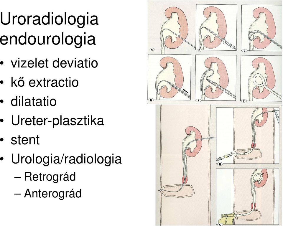 dilatatio Ureter-plasztika stent