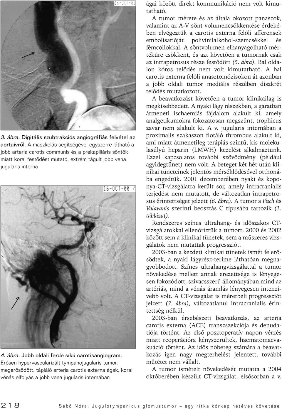 Jobb oldali ferde síkú carotisangiogram.